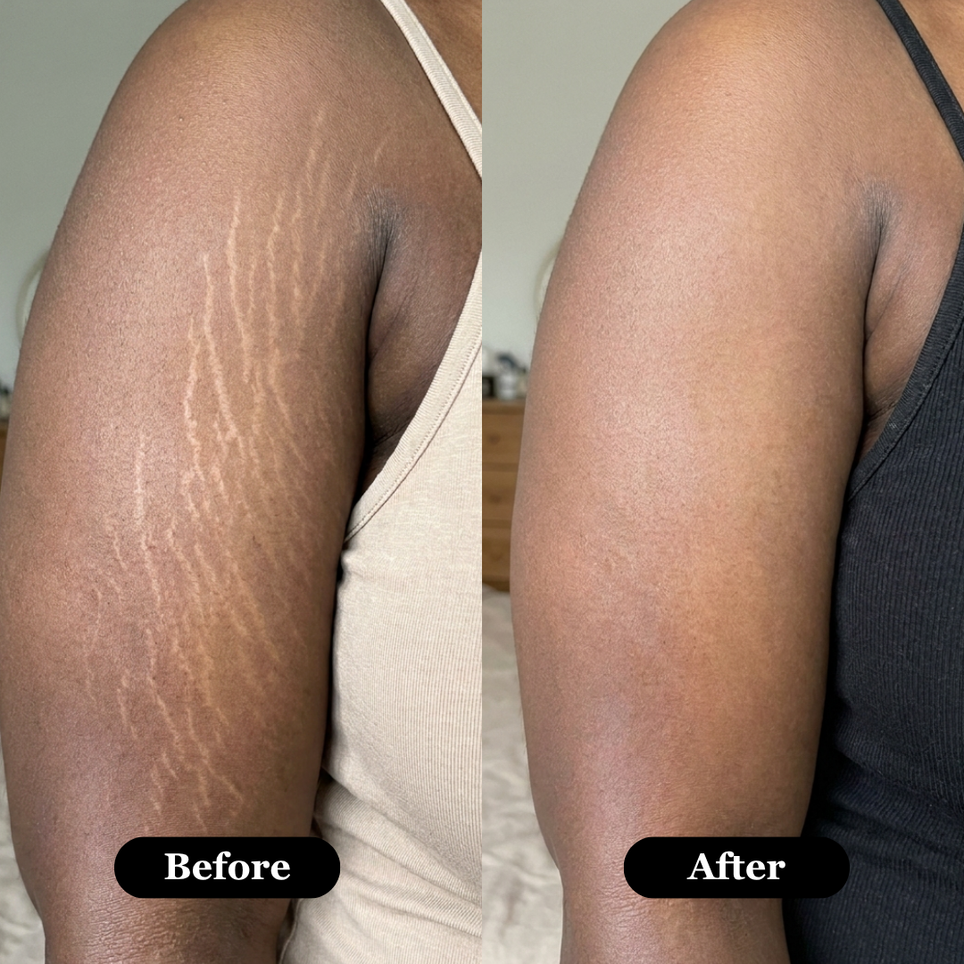 Maila Stretch Mark Serum